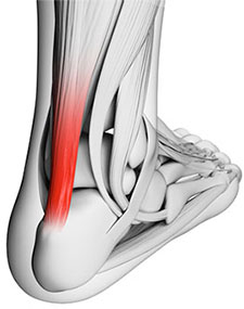 Achilles Tendinosis and Achilles Tendonosis: causes, symptoms and treatments