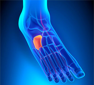 Cuboid Syndrome Treatment, University Foot and Ankle Institute