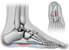Plantar Fribroma, University Foot and Ankle Institute