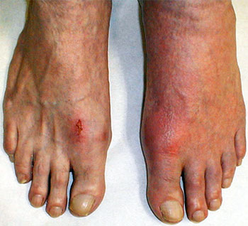 Treating a gout attack, University Foot and Ankle Institute