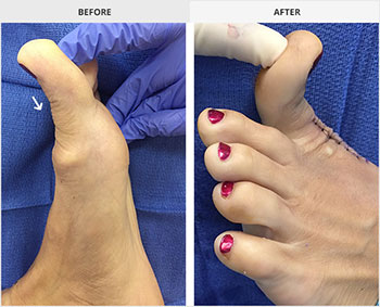 Hallux rigidus before and after, university foot and ankle institute