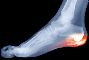Calcaneal Apophysitis, Severs Disease, Univeristy Foot and Ankle Institute