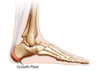 Growth Plate Injuries, University Foot and Ankle Institute