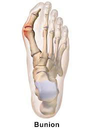 Bunion - University Foot and Ankle Institute - Los Angeles