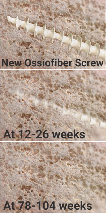 Ossiofiber surgical screw