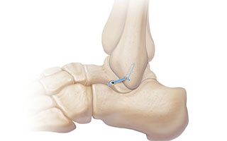 Internalbrace for Chronic Ankle Instability