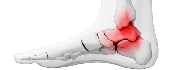 Ankle Arthritis, University Foot and Ankle Institute, Los Angeles