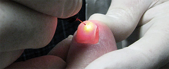 Our Laser Can Cure Your Toenail Fungus but How Do You Prevent Reinfection?