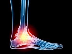 Ankle Replacement Surgery Options, University Foot and Ankle Institute, Los Angeles