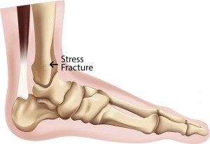 Stress Fracture, University Foot and Ankle Institute, Los Angeles