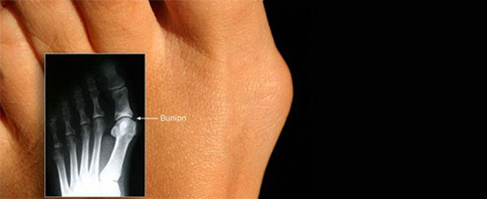 Bunion Surgery Options and Advancements