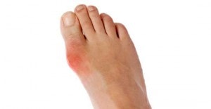 What is Gout, Gout Symtoms