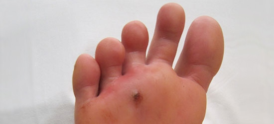 Foot Puncture Wound: A Hole in the Sole