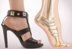 Shoes and Bunions, Bunion Treatment