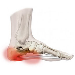 plantar fasciitis treatment options, heel pain and baseball