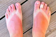 Sunburn on feet, summer and foot injuries