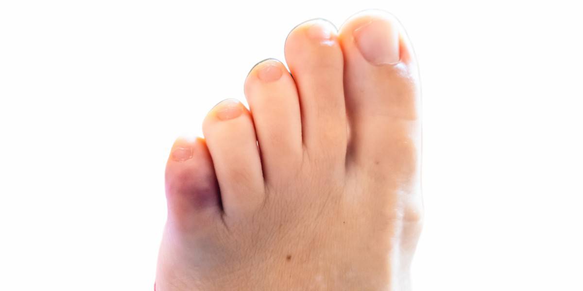 There’s nothing you can do for a broken toe…Or is there?