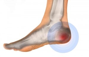 severe pain on back of heel