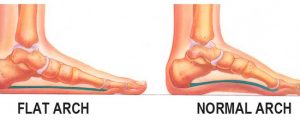 Flat Feet Arch vs Normal Arch, University Foot and Ankle Institute