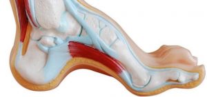 Underpronation and High Arch, University Foot and Ankle Institute