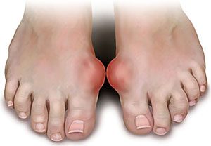 Medication and Side Effects and Gout