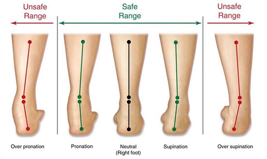 Overpronation and calf and low back pain, University Foot and Ankle Institute