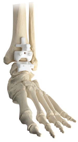 Wright Prophecy Ankle Replacement