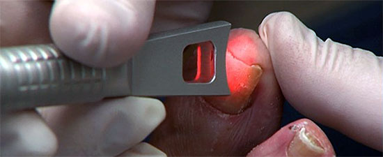 Q laser treatment for toenail fungus