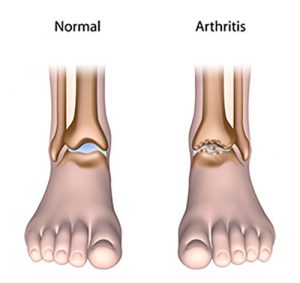 Image comparing healthy ankle to arthritis