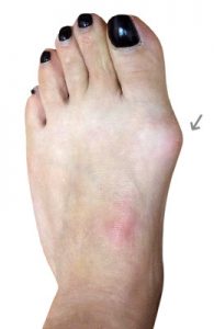 Bunions and Shoes, University Foot and Ankle Institute