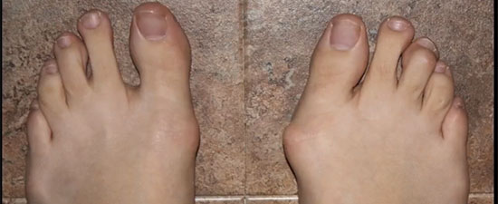 Bunion Surgery Success Story: One Dancer’s Experience with a Bunionectomy and UFAI [video]
