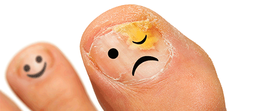 Toenail Falling Off? Here's What to Do