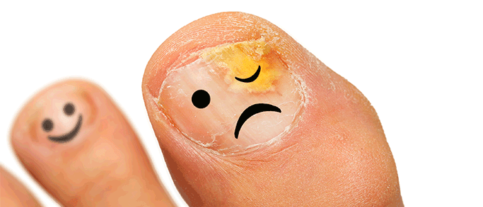 Help! My Toenail Is Falling Off! What do I do? | Foot & Ankle Blog