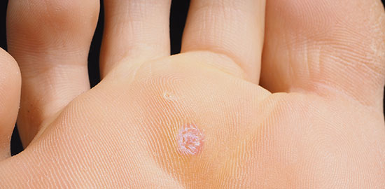 How to get rid of a plantar wart, Dr. gary briskin, foot and ankle specialist, Los Angeles