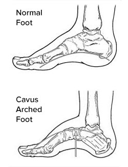Normal foot and foot with Pes Cavus