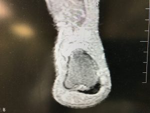 Plantar Fascia Imaging, Advanced Foot and Ankle Care Los Angeles