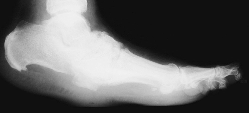 Charcot foot Neuropathic Arthropathy