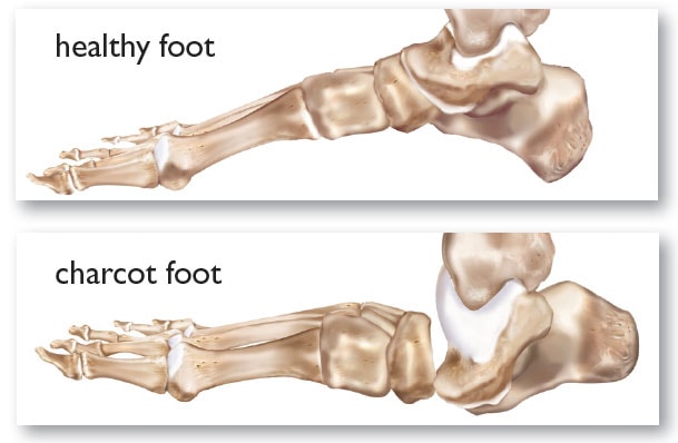 Comparison of a healthy foot and charcot foot