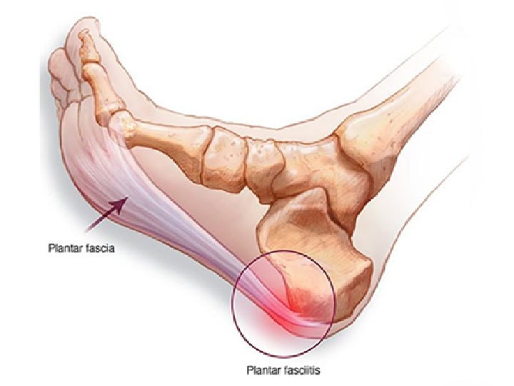 Why Do My Feet Hurt 10 Common Causes Of Foot Pain