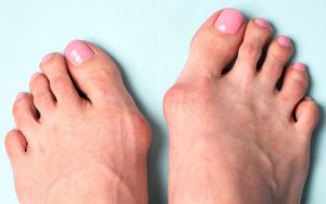 Best Treatment for Bunions