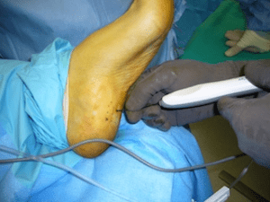 Topaz procedure for chronic plantar fasiitis and heel pain, University Foot and Ankle Institute