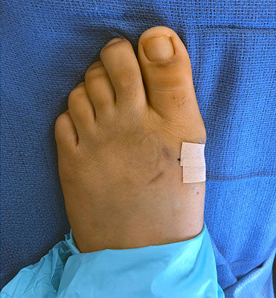 MinVasive bunion surgery, before and after minimally invasive bunion surgery