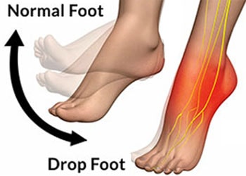 Drop foot explained