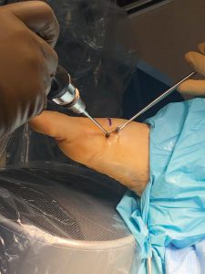 Minimally Invasive Bunion Surgery