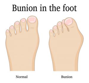 Bunions and Big Toe Bumps