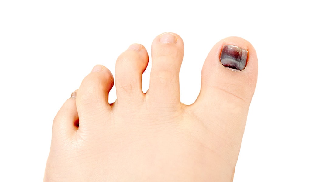 What Causes a Black Toenail? Should You Be Worried?