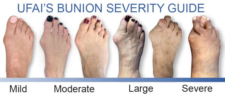 Non Surgical Bunion Treatments Everything You Want To Know