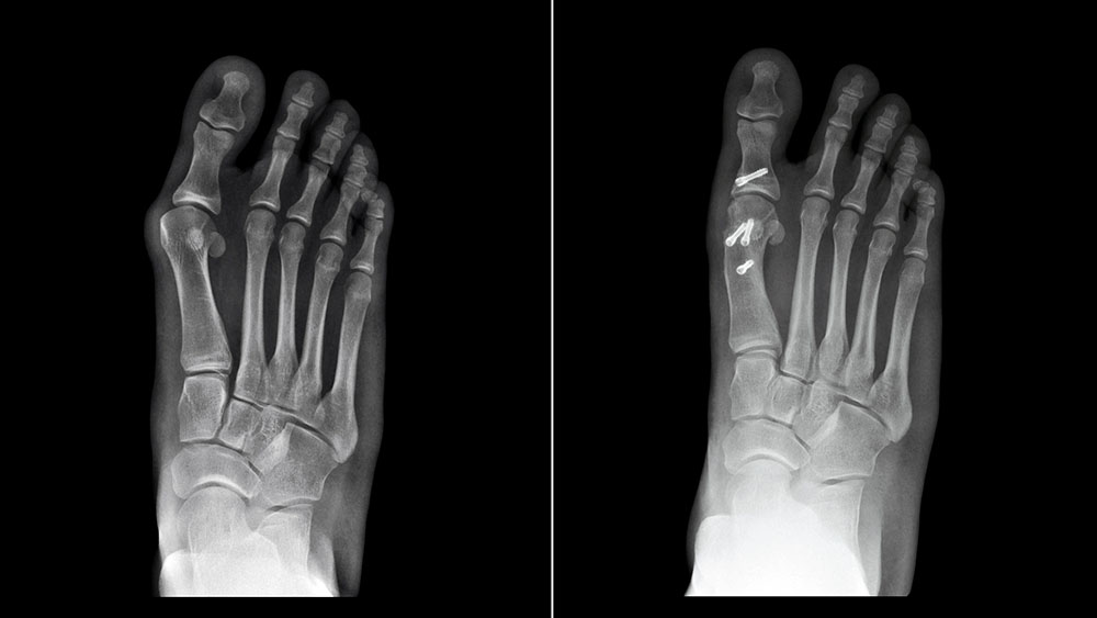 Before and after bunion surgery - Bunion Surgery Technology