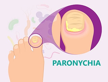 Illustration of Paronychia Toenail Infection