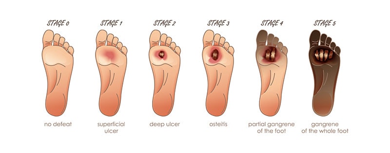 Diabetic foot ulcer, University Foot and Ankle Institute